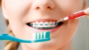 Tout sur les brosses à dents pour appareils orthodontiques
