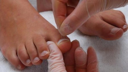 Uñas de los pies al crecer: causas y tratamientos