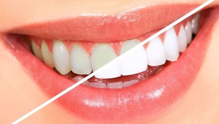 Hoe tanden bleken thuis?