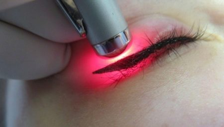 Odstranění tetování očních víček