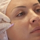 Facial mesotherapy: what is it and how is it carried out?
