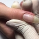 Features of the extension of a broken nail
