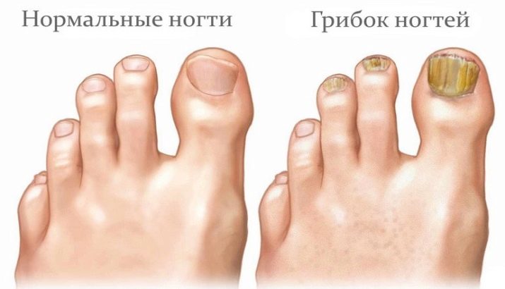 sifon în tratamentul ciupercii unghiilor de la picioare)