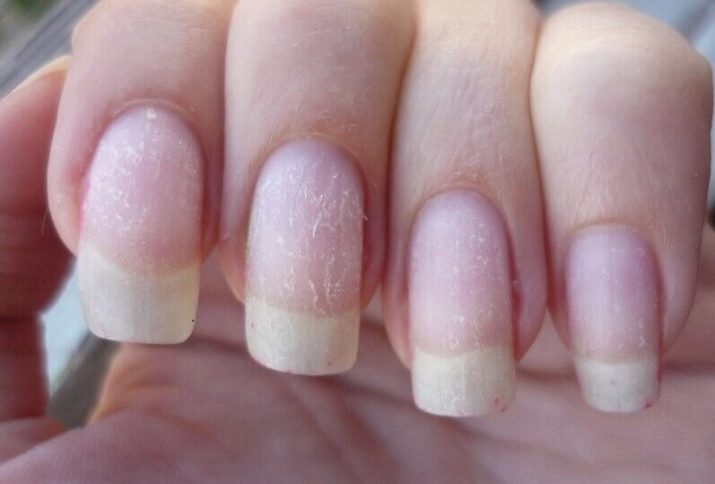 cum să restabiliți unghiile după o ciupercă pe mâini